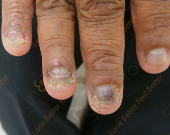 Nail Infection